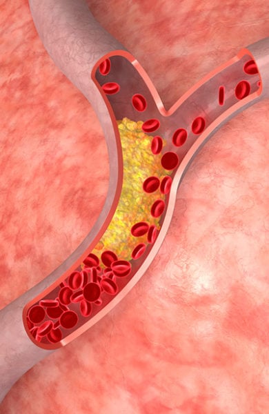 Angioplasty & Atherosclerosis