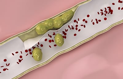 Understanding your cholesterol numbers will help you stabilize the plaque in your bloodstream.