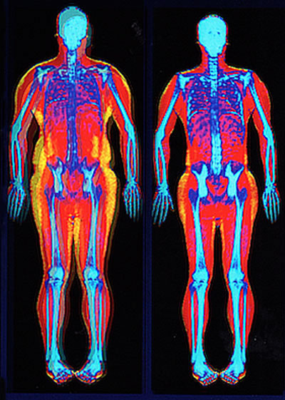 Belly Fat Loss Shown In DEXA Body Scan