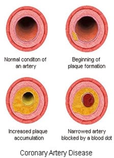 Prevent a Second Heart Attack By Preventing Plaque Growth.