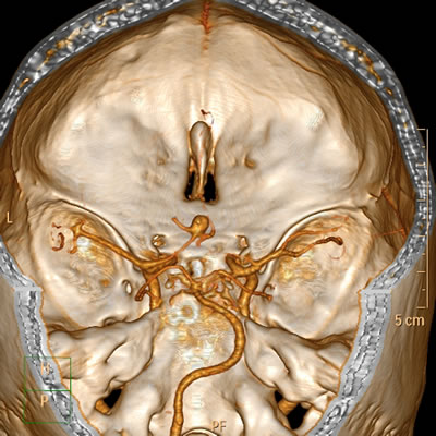 A Computerized Tomography Angiography may help you determine if you have heart disease.