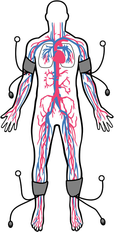 At the Pritikin Longevity Center, the physicians regularly use the brachial-ankle index test to diagose PAD (peripheral disease and poor circulation.