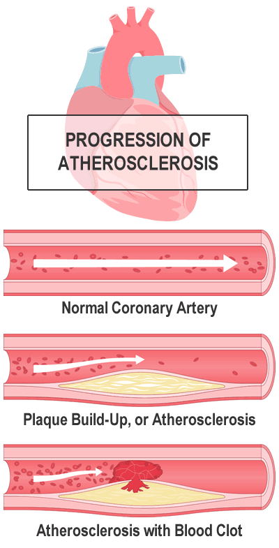 Natural Progression of Atherosclerosis