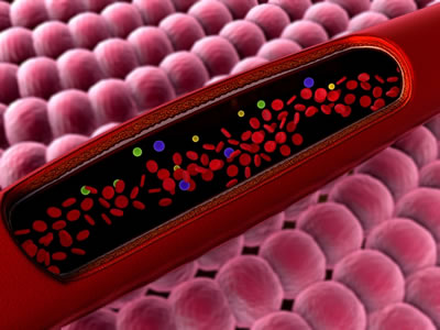 When the carotid arteries are filled with plaque, they begin to narrow.