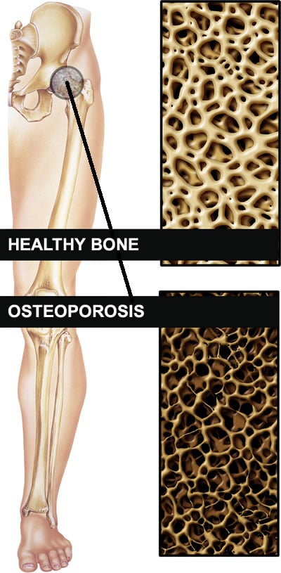 How To Strengthen Bones Naturally