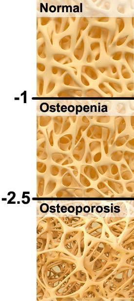 You T-Score Is Your Risk of Osteopenia and Osteoporosis