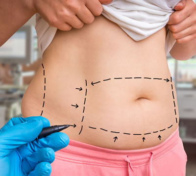 Liposuction and Reducing the Number of Fat Cells
