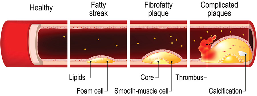 Progression of Heart Disease and Your Calcium Score